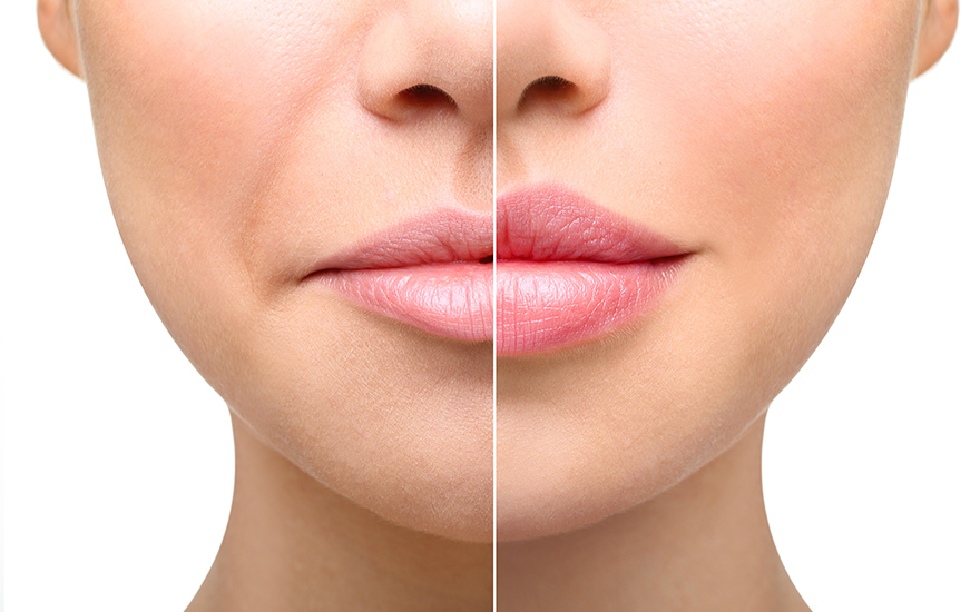頬のたるみとほうれい線を解消するための画期的な治療方法について