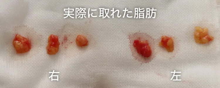 実際に取れた脂肪