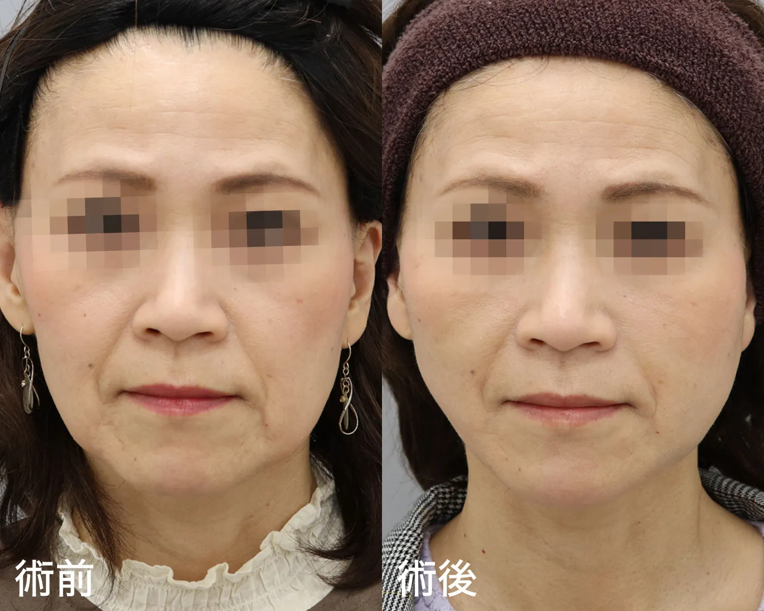 症例写真正面