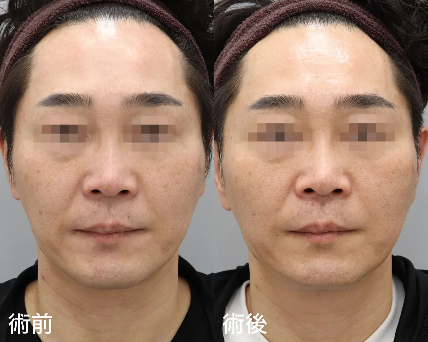 症例写真正面