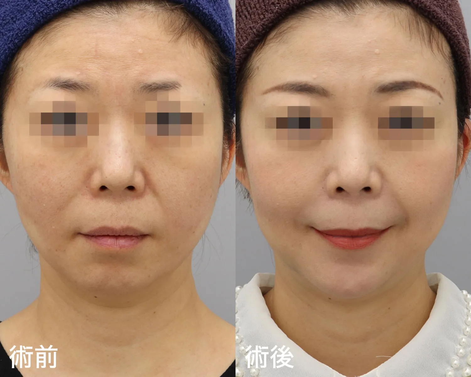 症例写真正面