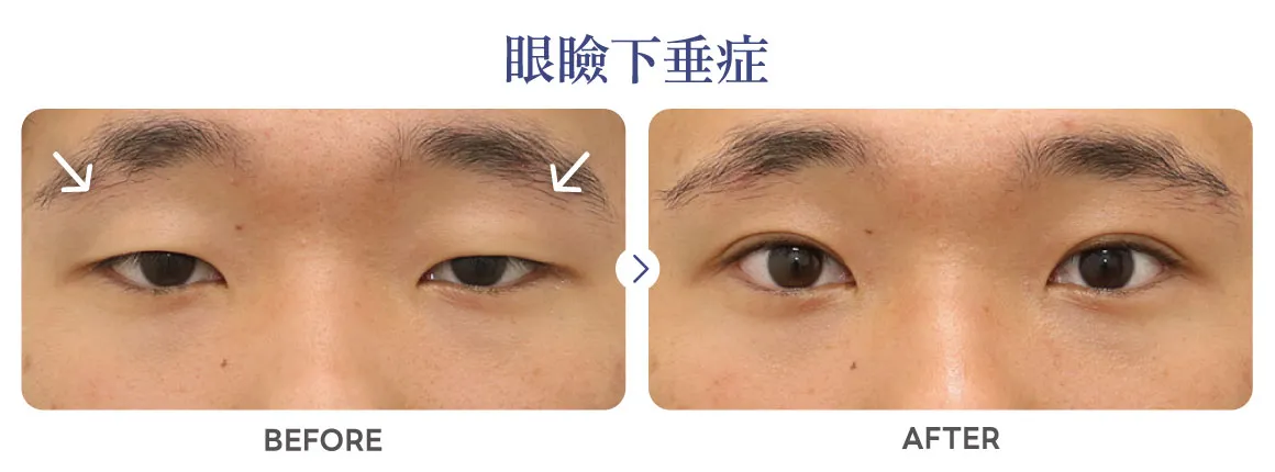 眼瞼下垂症症例写真