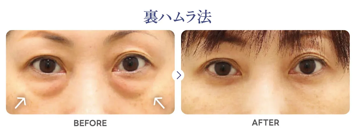 裏ハムラ症例写真