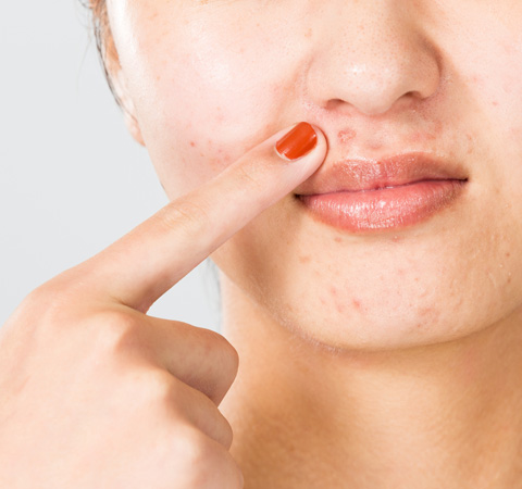 ニキビ・ニキビ跡