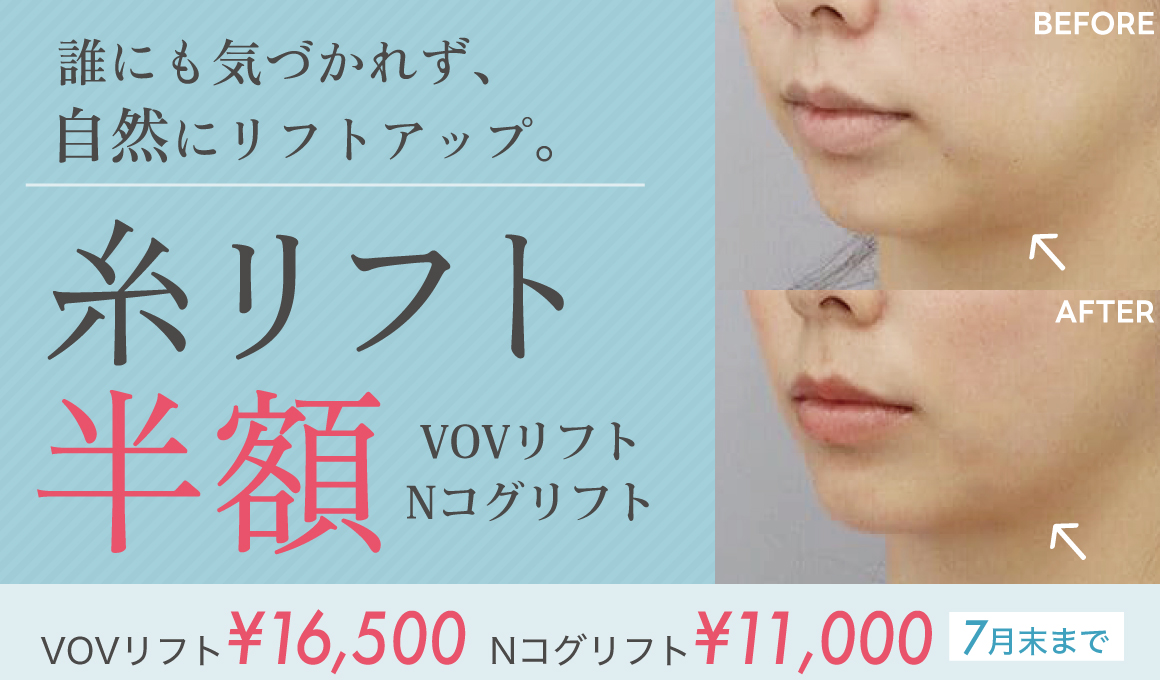 糸リフト半額