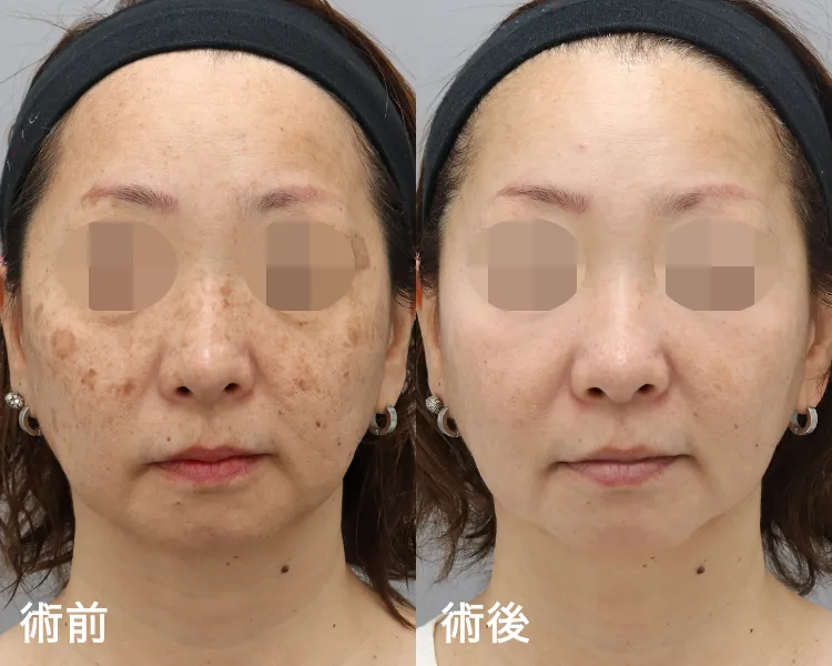 セラピューティック治療