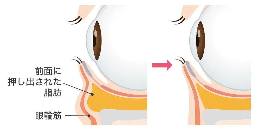 経結膜脱脂法イメージ
