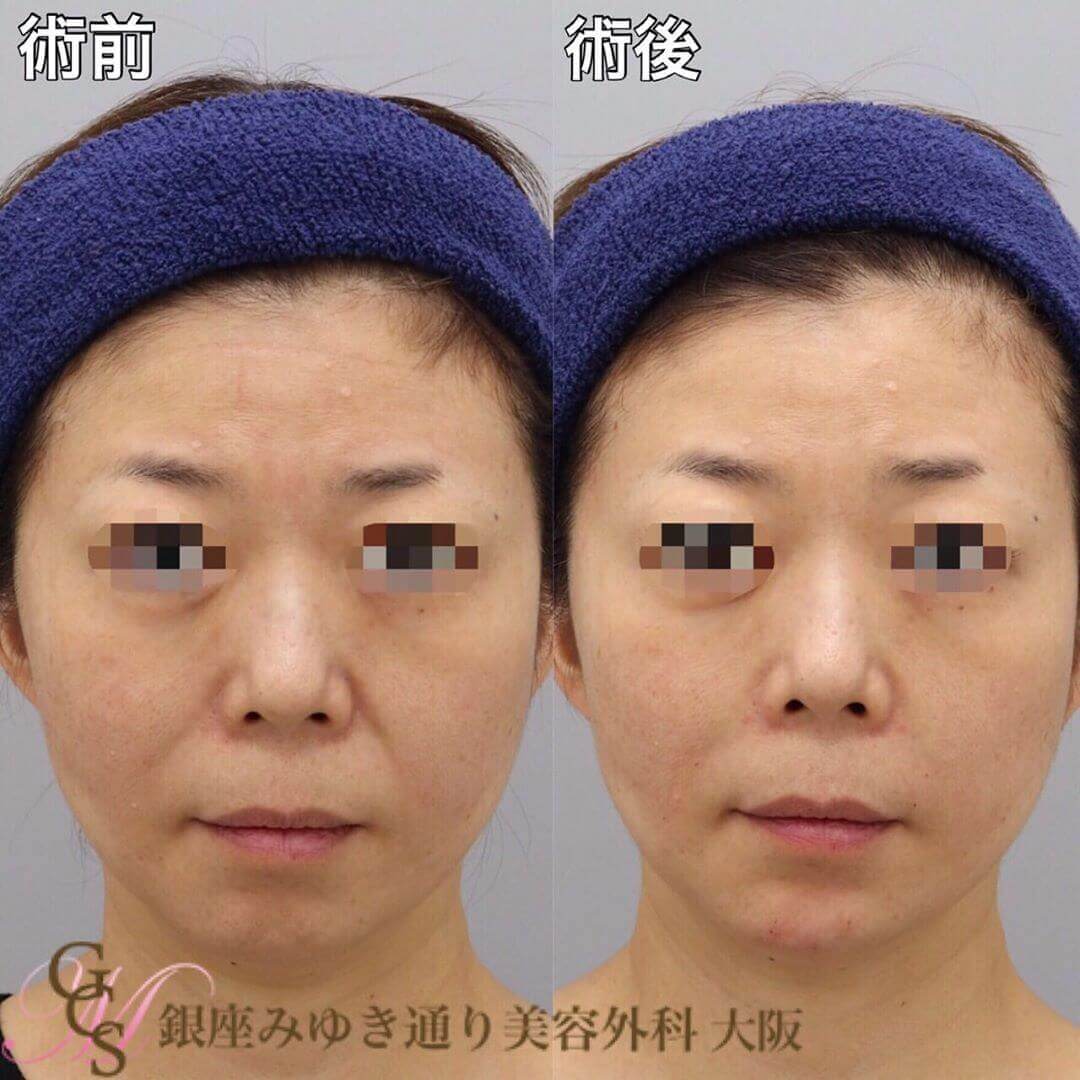 case03